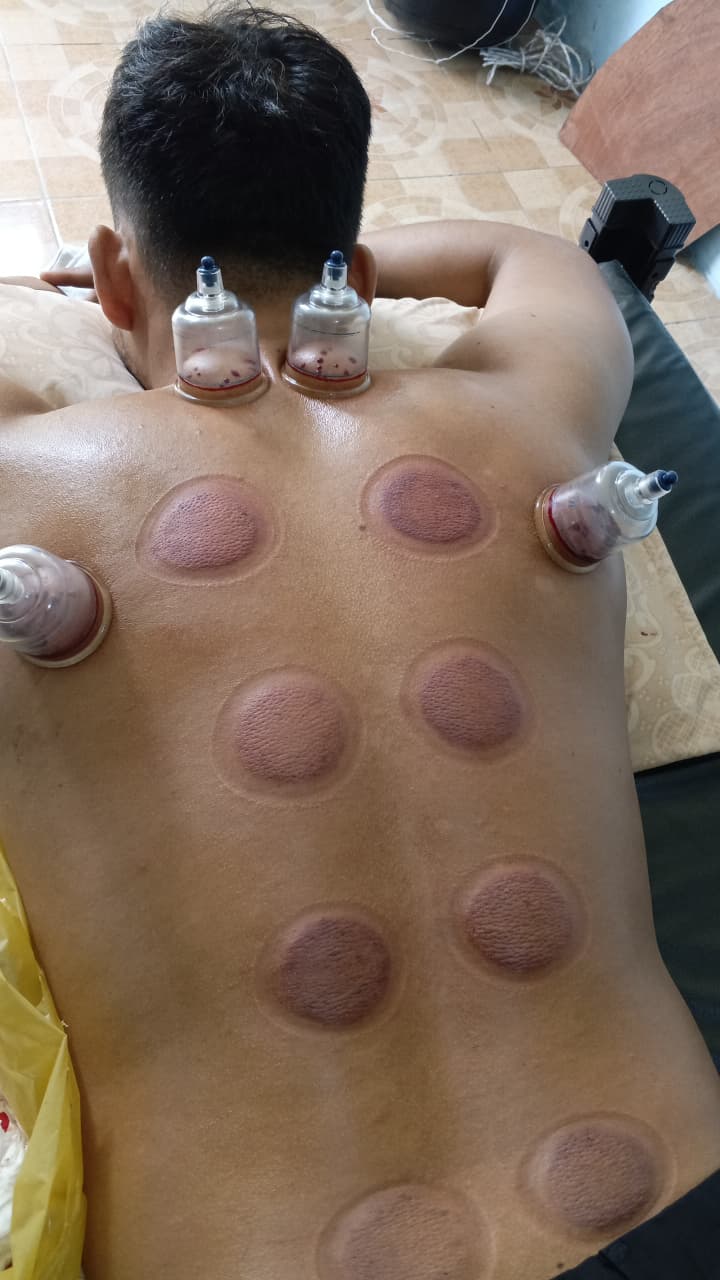 Bekam